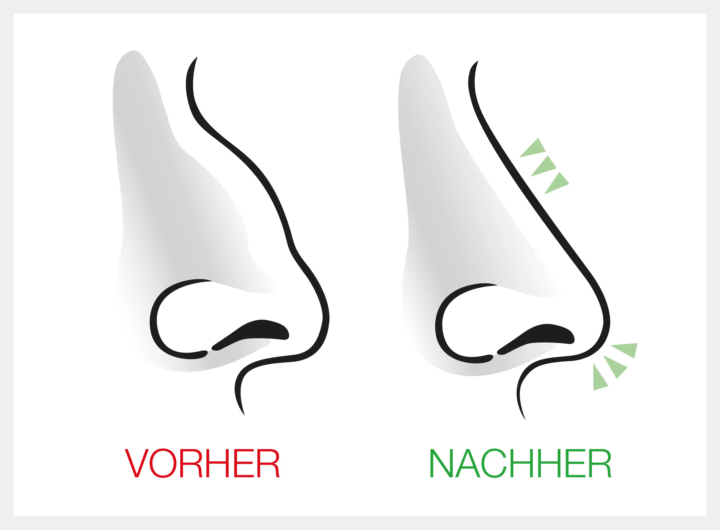 Nasenscheidewand OP