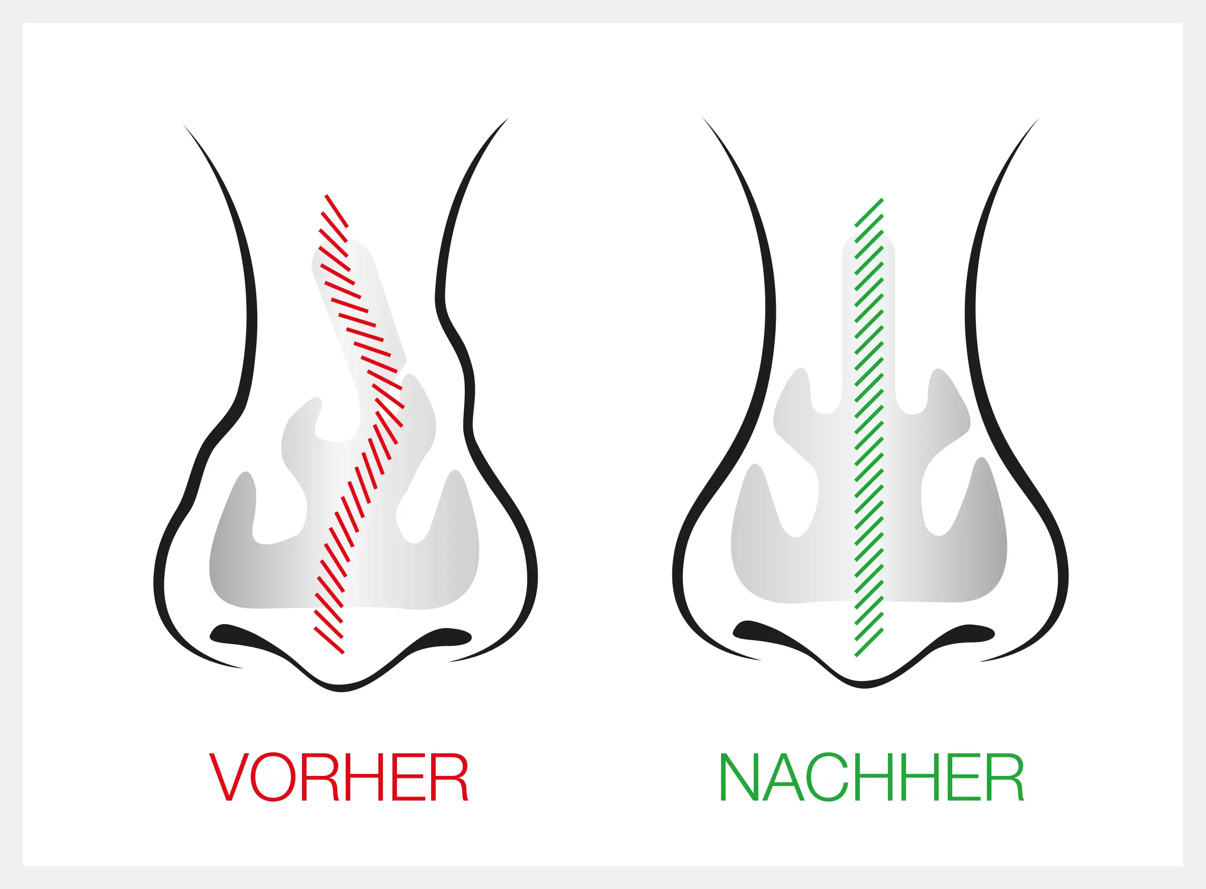 Nasenscheidewand OP