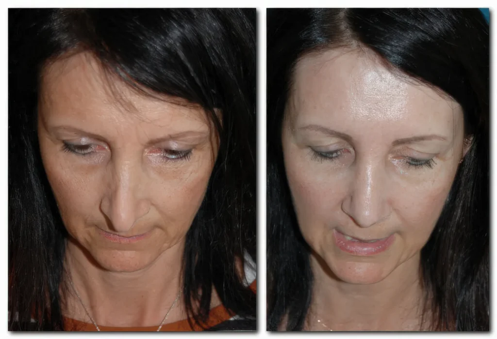 Asymmetrische überlange Nasenspitze