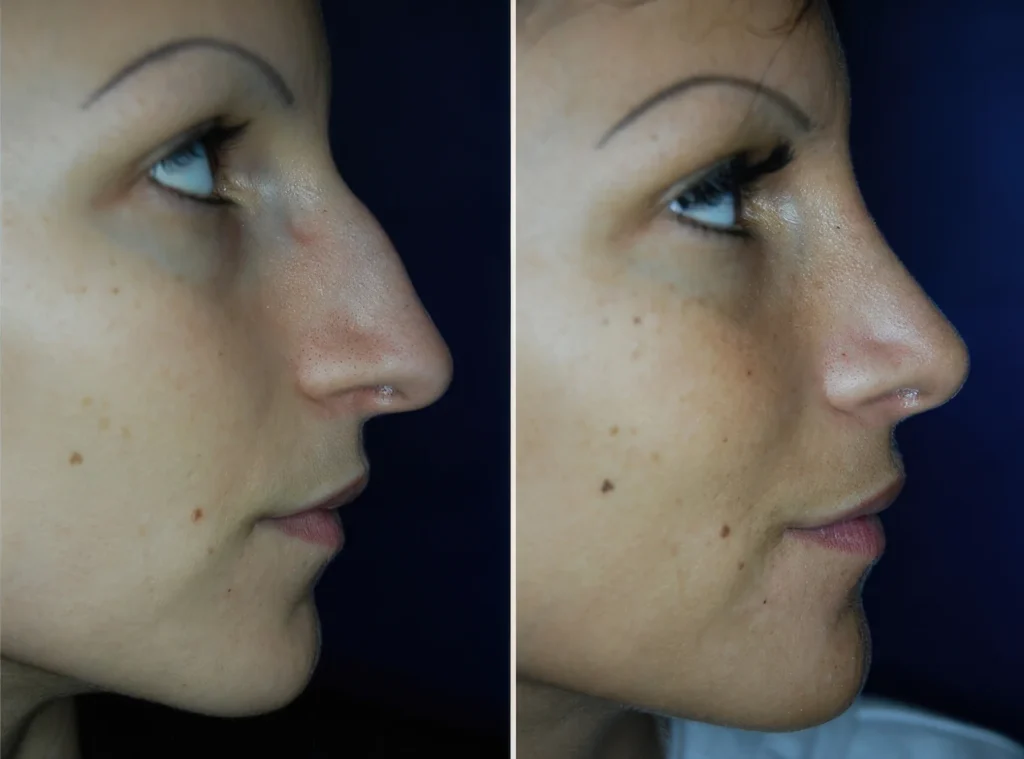 Rhinoplastik