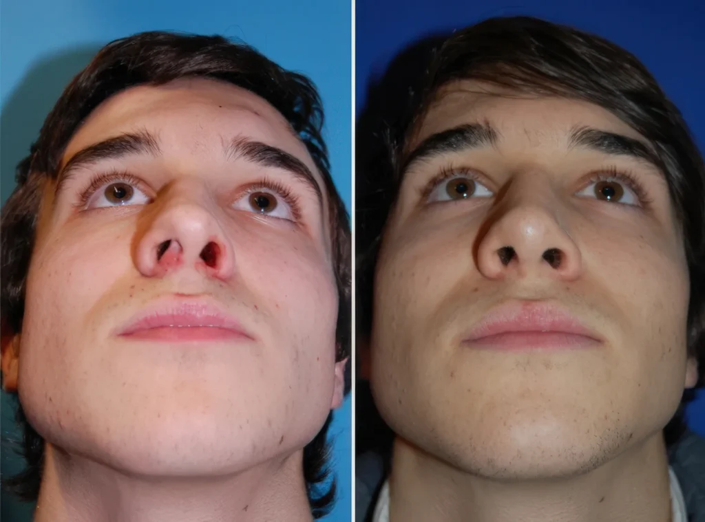 Septumdeviation